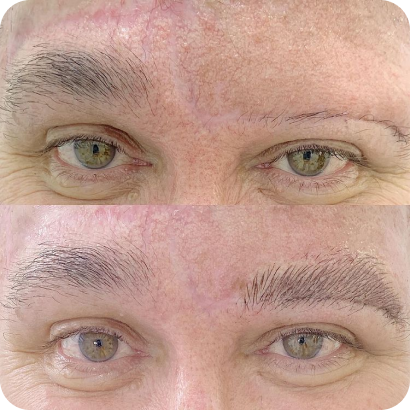 Antes e depois de micropigmentação de sobrancelhas em paciente oncológica