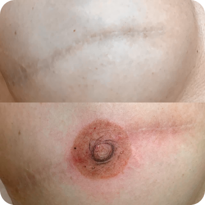 Resultado de reconstrução mamária gratuita com adesivo personalizado